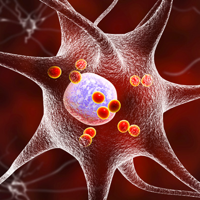 Immune system may play harmful role in Lewy body dementia